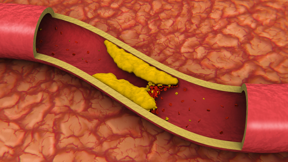 oxidized LDL cholesterol particles heart disease