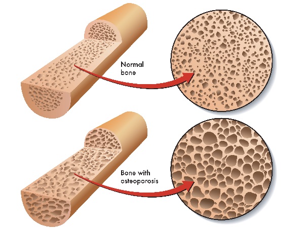 osteoporosis-bone-leaching-calcium