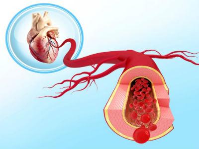heart-disease-inflammation