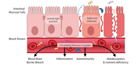 leaky-gut-intestinal-permeability-auto-immunity